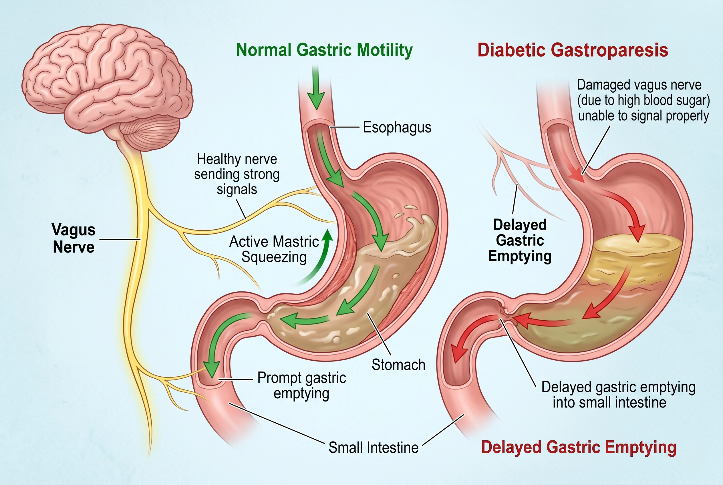 Medical illustration showing how vagus nerve damage in diabetes slows down stomach emptying and digestion.